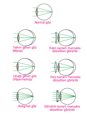 Goz Kusurlari Bilgicik Com Bilgicik Com