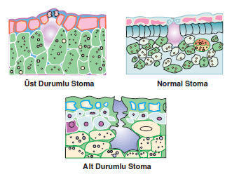 stoma_sekilleri