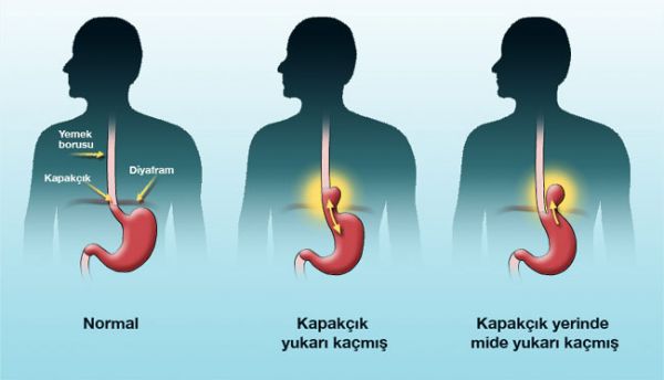 mide yanmasi nedir neden olur nasil gecer bilgicik com bilgicik com