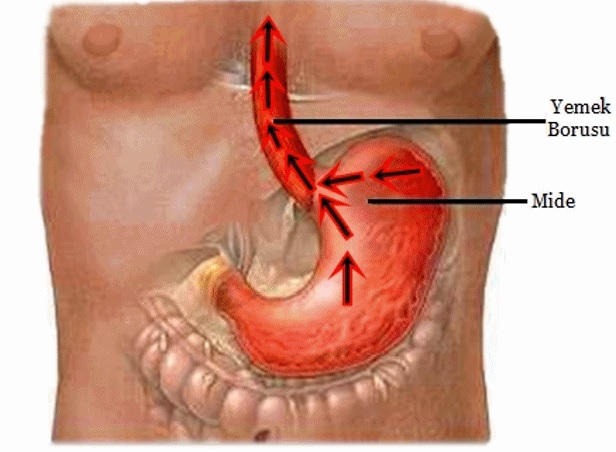 mide-yanması-nedeni